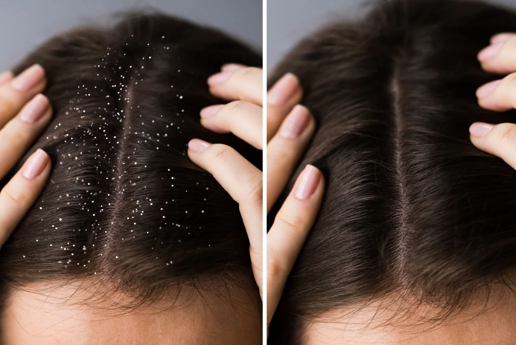 Signs of Scalp Buildup and How to Deep Clean Your Scalp